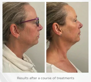 Radiofrequency + DMA Facial